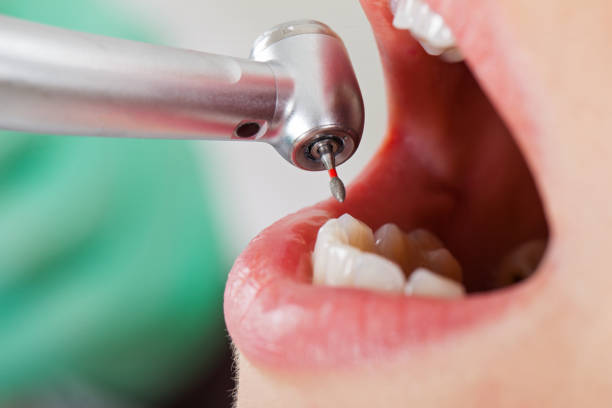 Best Emergency Wisdom Teeth Removal in Ferrum, VA